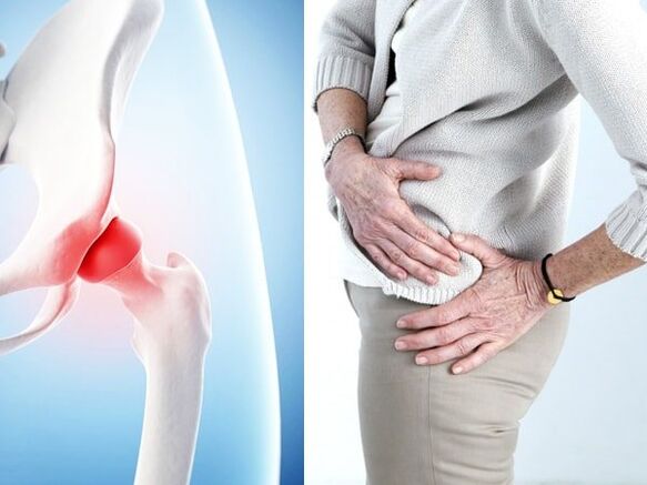 sintomi di artrosi dell'articolazione dell'anca