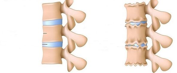 una colonna vertebrale sana e l'osteocondrosi