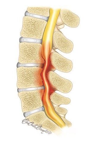 Con l'osteocondrosi della colonna vertebrale toracica, si verifica la compressione del canale spinale
