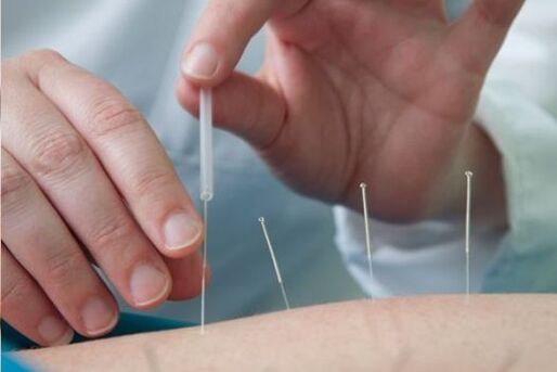 Agopuntura - un metodo per trattare il dolore nella regione lombare causato dall'osteocondrosi
