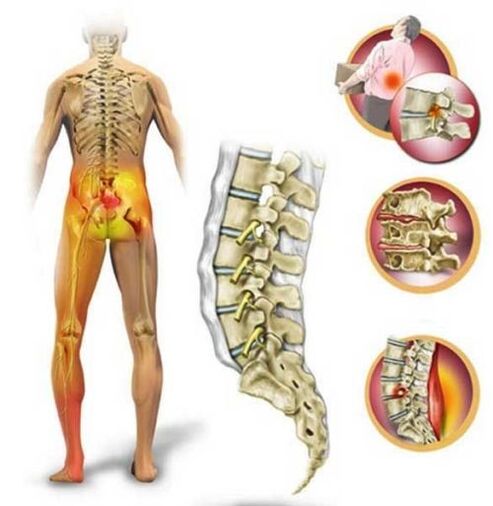 Osteocondrosi della colonna lombare, che causa mal di schiena