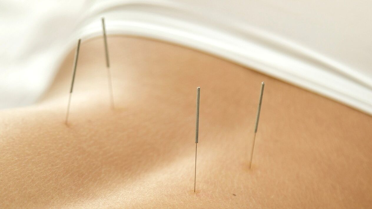 L'agopuntura aiuterà a sbarazzarsi del dolore lombare