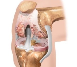 La cartilagine nel ginocchio