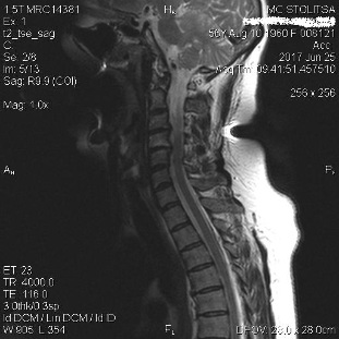 Osteocondrosi spondilosi cervicale della colonna vertebrale